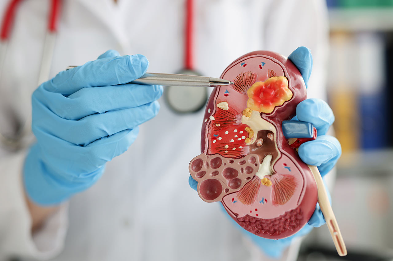 chronic kidney disease agence cabinet conseil consulting